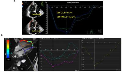 Assessment of right ventricular remodeling in chronic thromboembolic pulmonary hypertension by 2D-speckle tracking echocardiography: A comparison with cardiac magnetic resonance